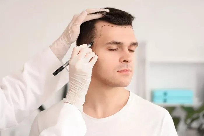 Hair Transplant