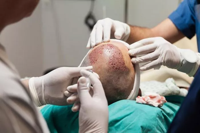 FUE Hair Transplant