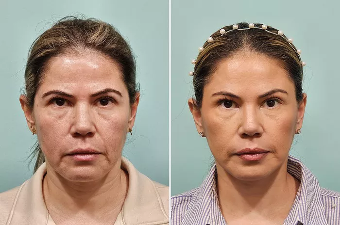 Facelift