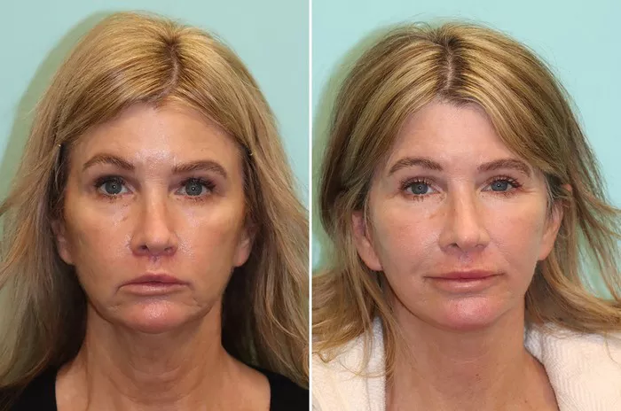 Facelift