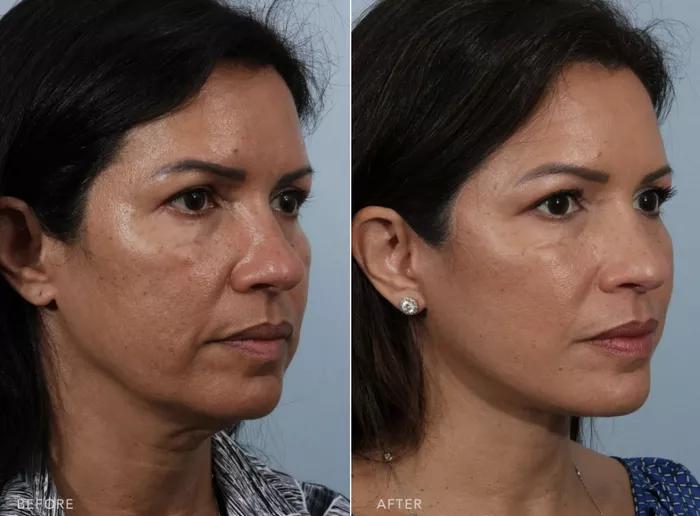 Facelift